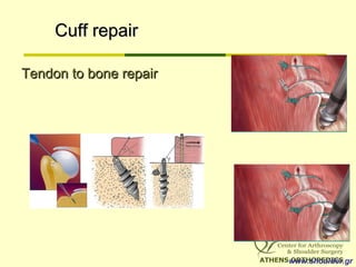 Cuff repairCuff repair
Tendon to bone repairTendon to bone repair
www.shoulder.gr
 