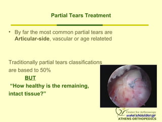 Partial Tears Treatment
• By far the most common partial tears are
Articular-side, vascular or age relateted
Traditionally partial tears classifications
are based to 50%
BUT
“How healthy is the remaining,
intact tissue?”
www.shoulder.gr
 