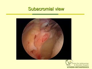Subacromial viewSubacromial view
 