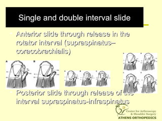 Single and double interval slideSingle and double interval slide
• Anterior slide through release in theAnterior slide through release in the
rotator interval (supraspinatus–rotator interval (supraspinatus–
coracobrachialis)coracobrachialis)
• Posterior slide through release of thePosterior slide through release of the
interval supraspinatus-infraspinatusinterval supraspinatus-infraspinatus
 