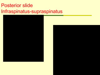 Posterior slide
Infraspinatus-supraspinatus
 