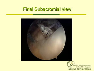 Final Subacromial viewFinal Subacromial view
 
