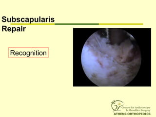 Subscapularis
Repair
Recognition
 