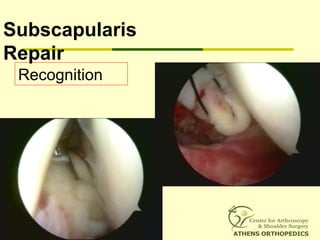 Subscapularis
Repair
Recognition
 