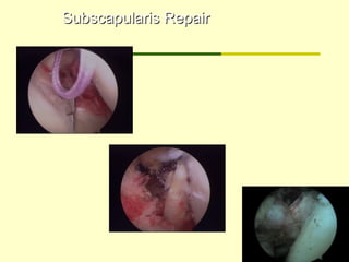 Subscapularis RepairSubscapularis Repair
 