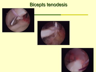 Bicepts tenodesisBicepts tenodesis
 
