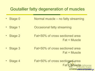 Goutallier fatty degeneration of muscles
• Stage 0 Normal muscle – no fatty streaming
• Stage 1 Occasional fatty streaming...
