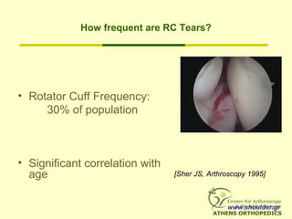How frequent are RC Tears?
• Rotator Cuff Frequency:
30% of population
• Significant correlation with
age [Sher JS, Arthro...