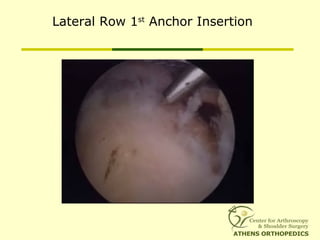 Lateral Row 1st
Anchor Insertion
 