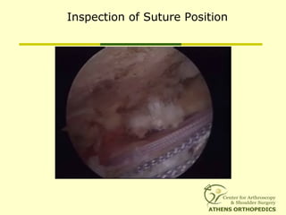 Inspection of Suture Position
 