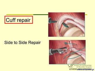 Side to Side Repair
Cuff repair
www.shoulder.gr
 