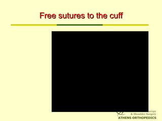 Free sutures to the cuffFree sutures to the cuff
 