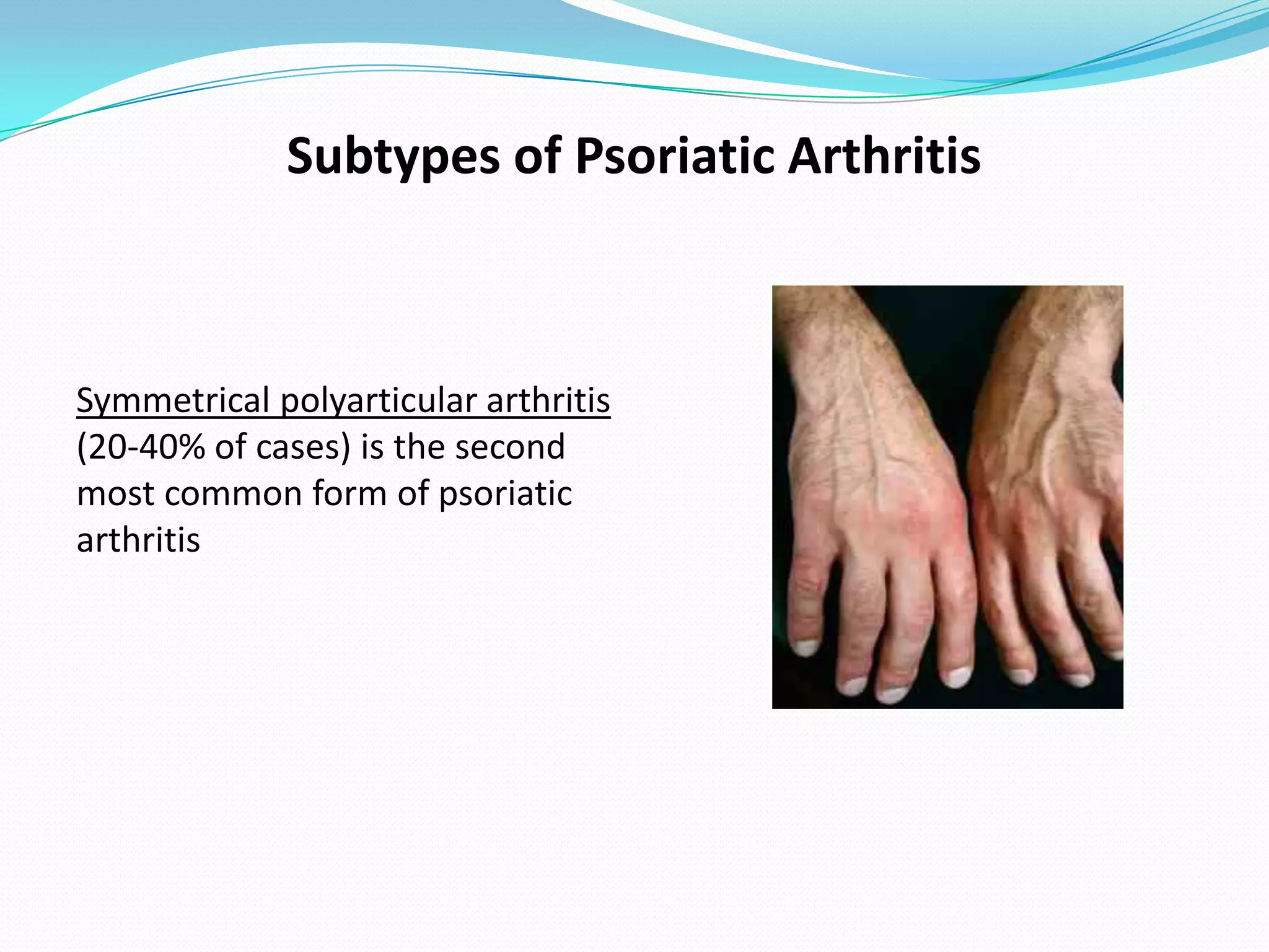 Subtypes of Psoriatic Arthritis



Symmetrical polyarticular arthritis
(20-40% of cases) is the second
most common form of psoriatic
arthritis
 