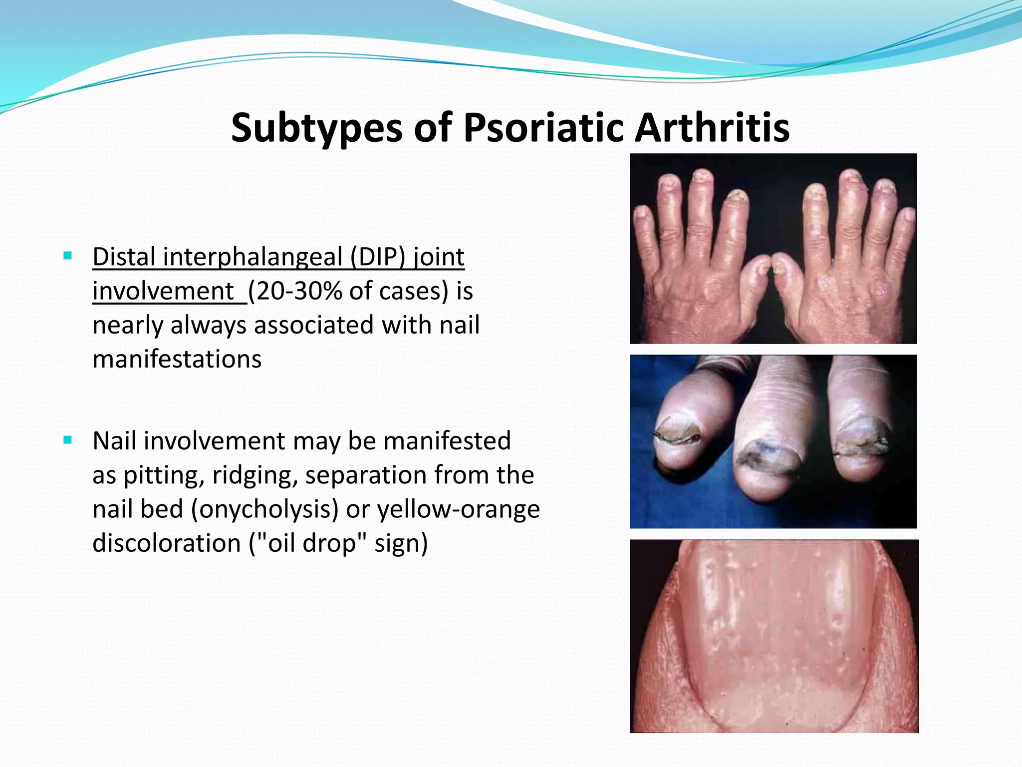 Subtypes of Psoriatic Arthritis

 Distal interphalangeal (DIP) joint
  involvement (20-30% of cases) is
  nearly always associated with nail
  manifestations

 Nail involvement may be manifested
  as pitting, ridging, separation from the
  nail bed (onycholysis) or yellow-orange
  discoloration ("oil drop" sign)
 