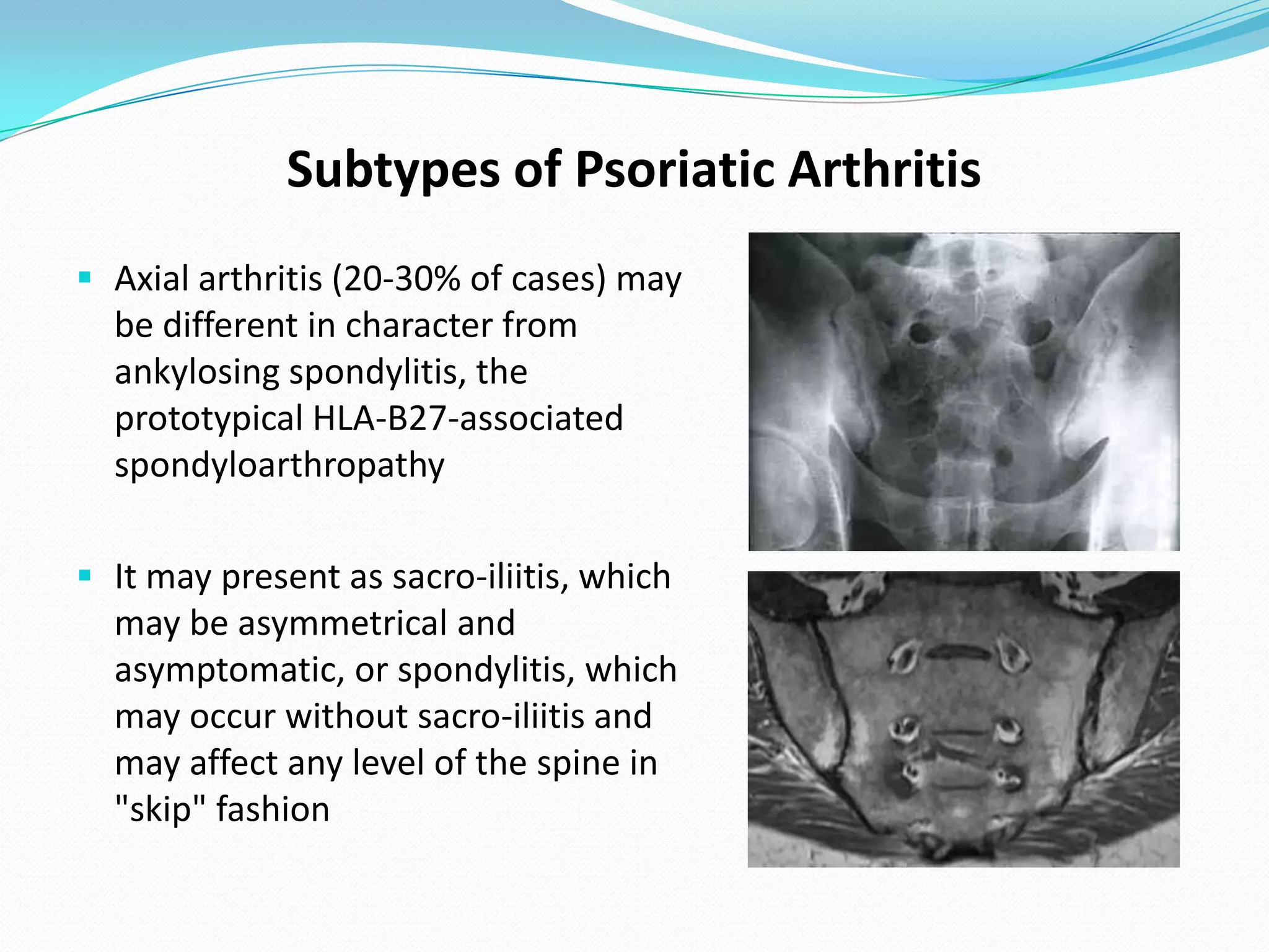 Subtypes of Psoriatic Arthritis
 Axial arthritis (20-30% of cases) may
  be different in character from
  ankylosing spondylitis, the
  prototypical HLA-B27-associated
  spondyloarthropathy

 It may present as sacro-iliitis, which
  may be asymmetrical and
  asymptomatic, or spondylitis, which
  may occur without sacro-iliitis and
  may affect any level of the spine in
  "skip" fashion
 