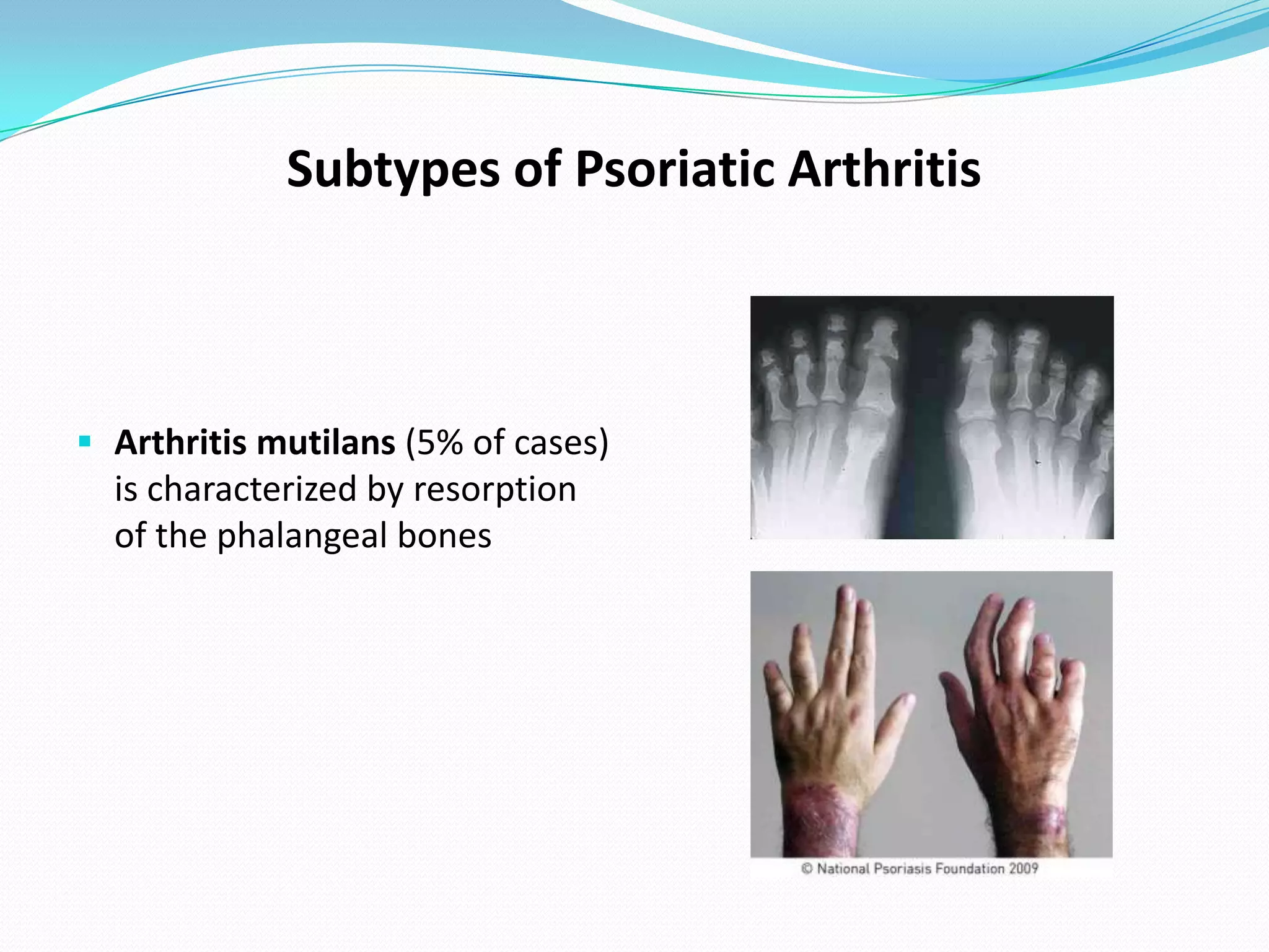 Subtypes of Psoriatic Arthritis



 Arthritis mutilans (5% of cases)
  is characterized by resorption
  of the phalangeal bones
 