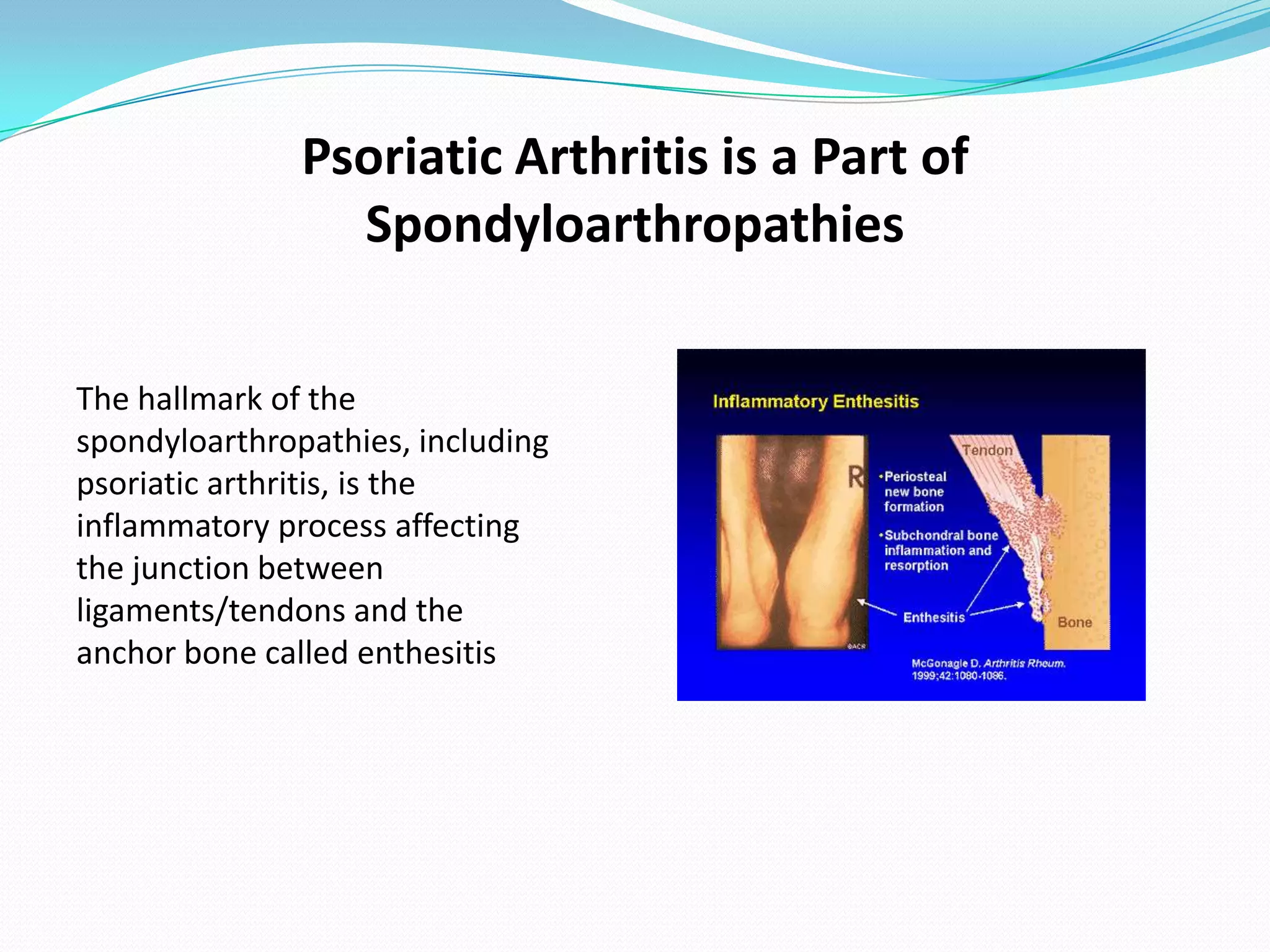 Psoriatic Arthritis is a Part of
                 Spondyloarthropathies

The hallmark of the
spondyloarthropathies, including
psoriatic arthritis, is the
inflammatory process affecting
the junction between
ligaments/tendons and the
anchor bone called enthesitis
 