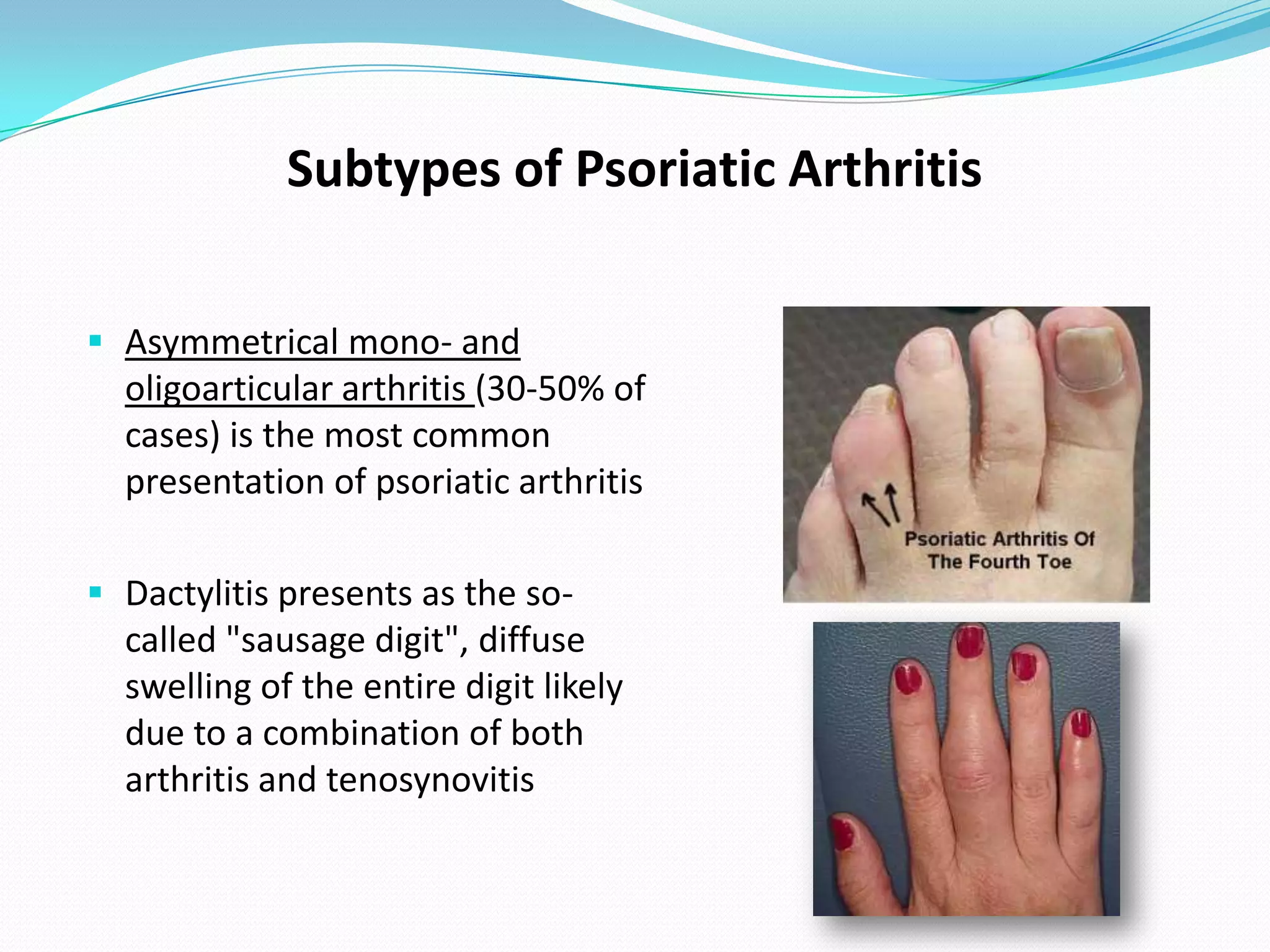 Subtypes of Psoriatic Arthritis

 Asymmetrical mono- and
  oligoarticular arthritis (30-50% of
  cases) is the most common
  presentation of psoriatic arthritis

 Dactylitis presents as the so-
  called "sausage digit", diffuse
  swelling of the entire digit likely
  due to a combination of both
  arthritis and tenosynovitis
 