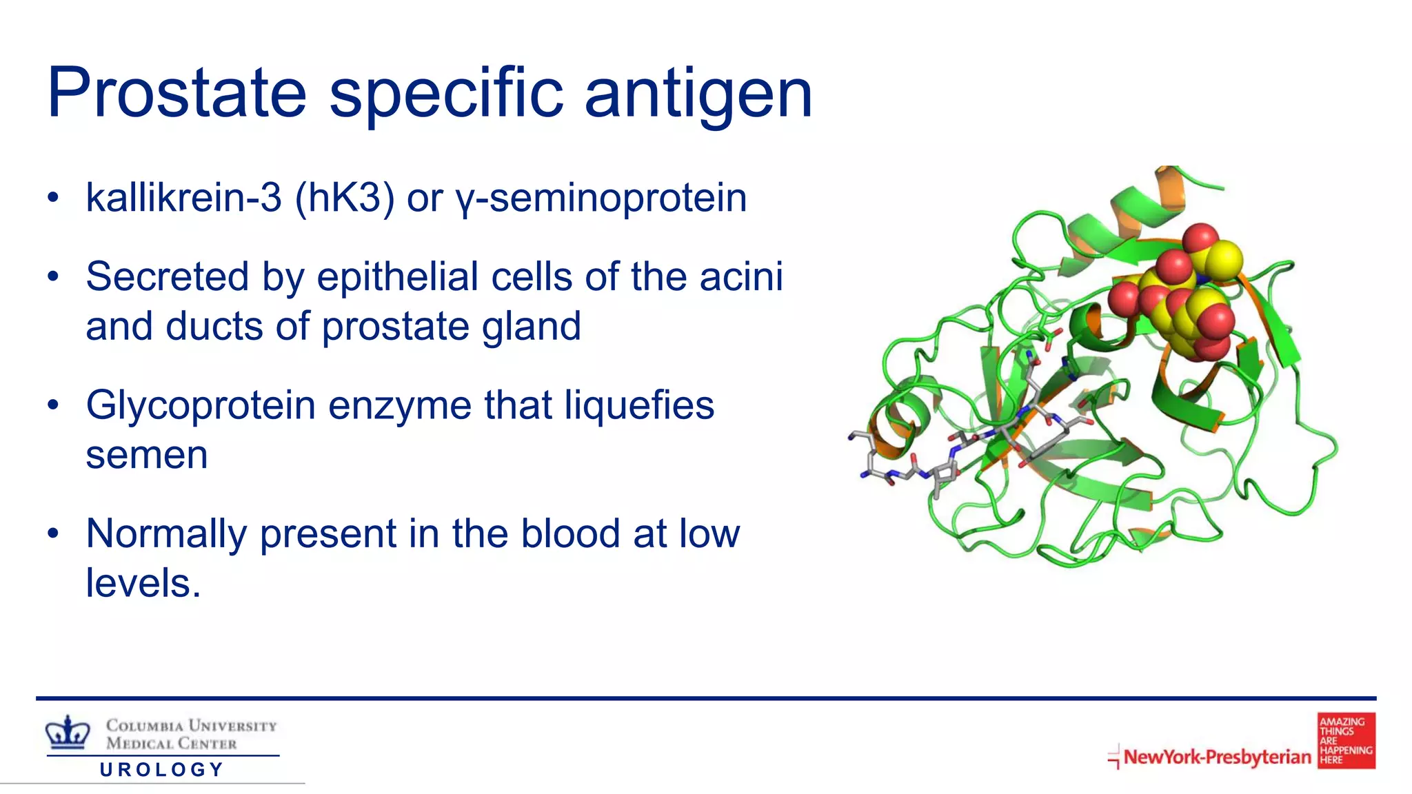 U R O L O G Y
Prostate specific antigen
• kallikrein-3 (hK3) or γ-seminoprotein
• Secreted by epithelial cells of the acini
and ducts of prostate gland
• Glycoprotein enzyme that liquefies
semen
• Normally present in the blood at low
levels.
 