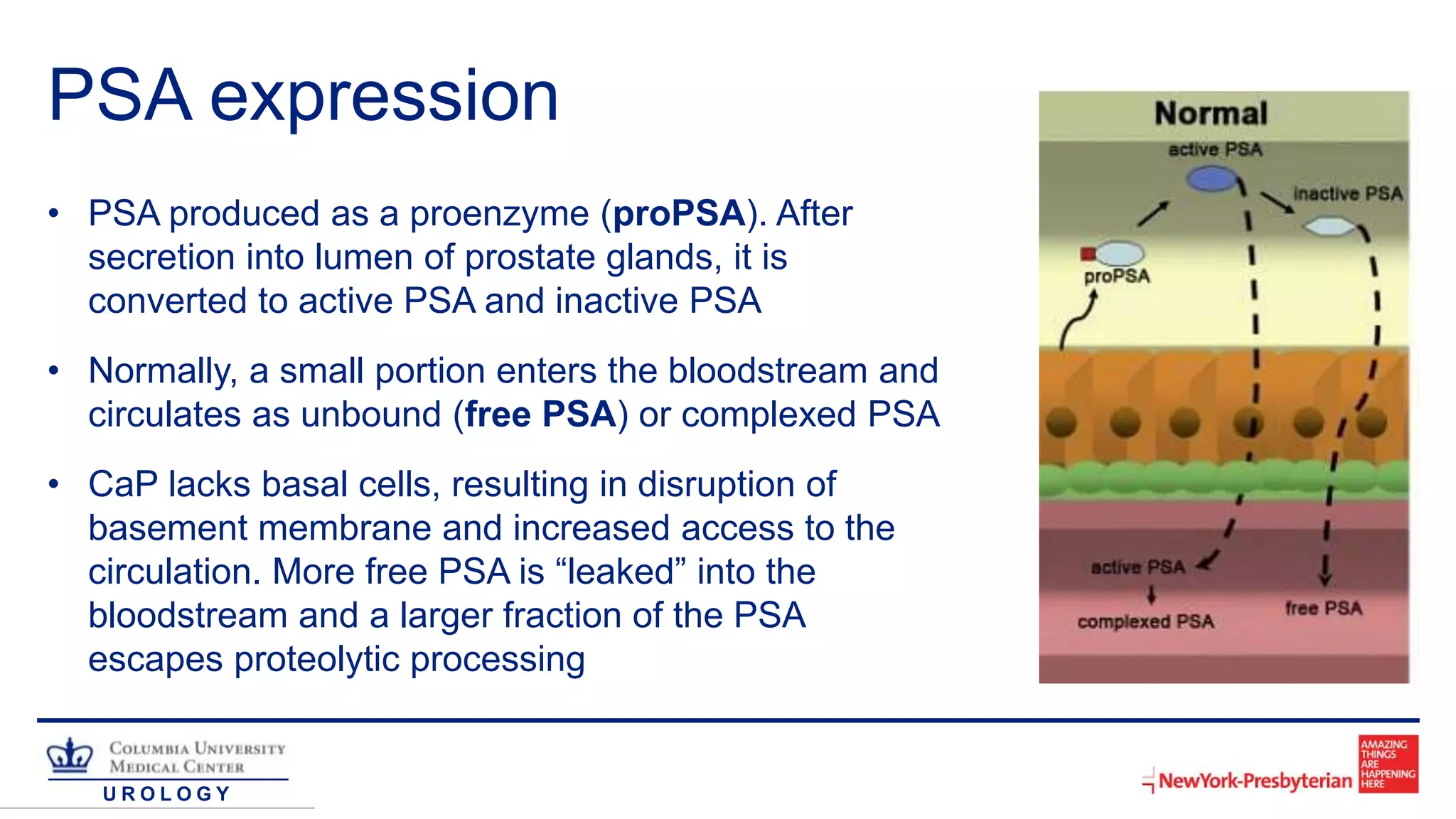 U R O L O G Y
PSA expression
• PSA produced as a proenzyme (proPSA). After
secretion into lumen of prostate glands, it is
converted to active PSA and inactive PSA
• Normally, a small portion enters the bloodstream and
circulates as unbound (free PSA) or complexed PSA
• CaP lacks basal cells, resulting in disruption of
basement membrane and increased access to the
circulation. More free PSA is “leaked” into the
bloodstream and a larger fraction of the PSA
escapes proteolytic processing
 