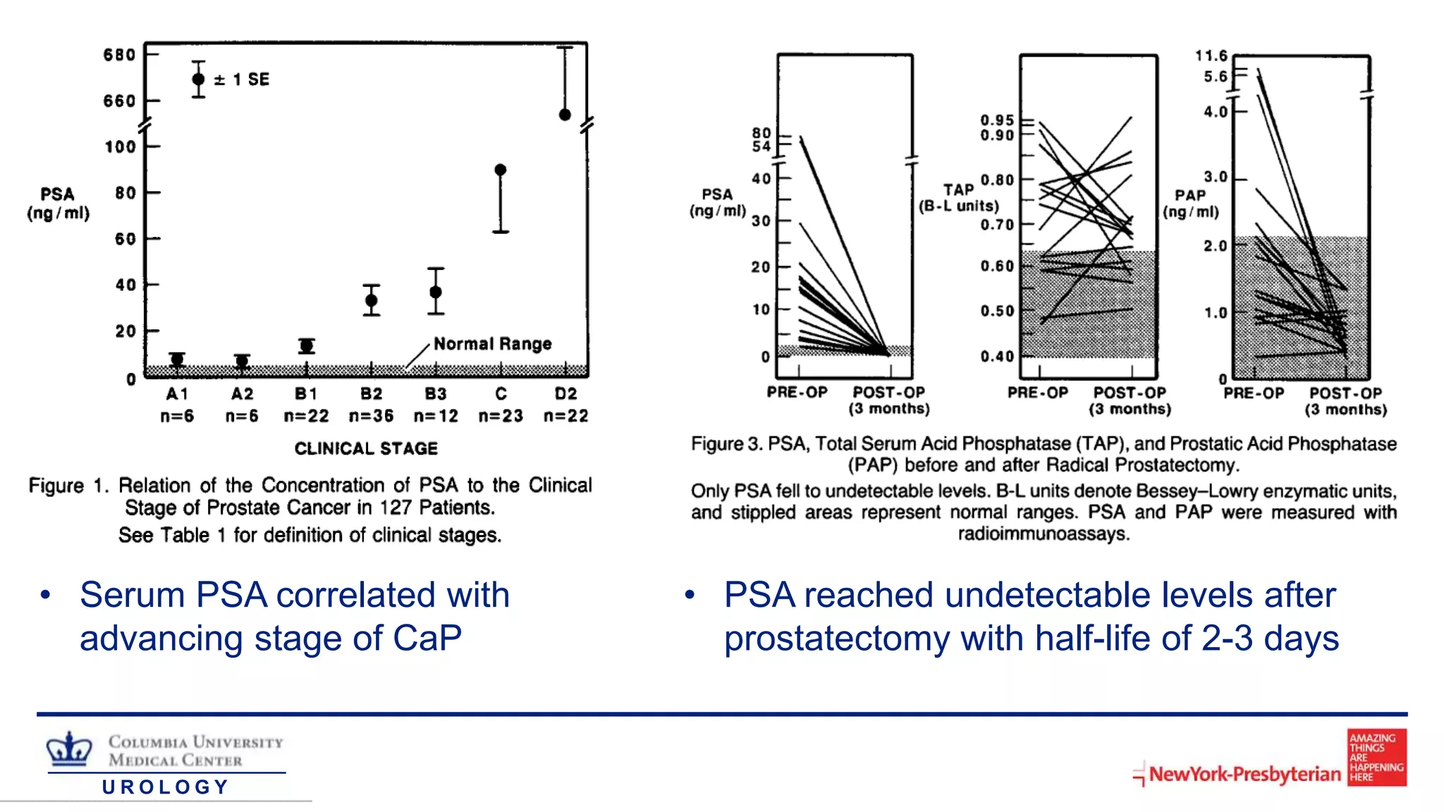 U R O L O G Y
• Serum PSA correlated with
advancing stage of CaP
• PSA reached undetectable levels after
prostatectomy with half-life of 2-3 days
 