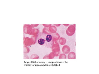 Pelger-Hüet anomaly - benign disorder, the
majorityof granulocytes are bilobed
 