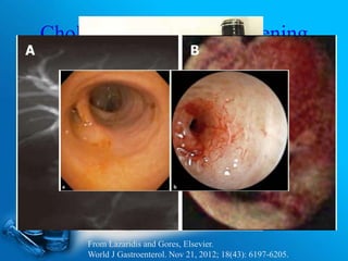 Cholangiocarcinoma Screening
 FISH: Flouresence in situ hybridization.
Brush cytology using EUS-FNA.
Cholangioscopy.
From Lazaridis and Gores, Elsevier.
World J Gastroenterol. Nov 21, 2012; 18(43): 6197-6205.
 