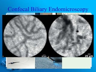 Confocal Biliary Endomicroscopy
 