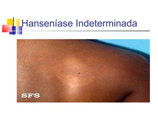 Hanseníase Indeterminada
 