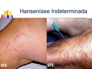 Hanseníase Indeterminada
 