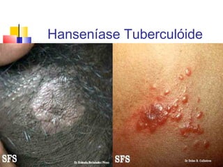 Hanseníase Tuberculóide

 