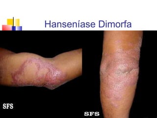 Hanseníase Dimorfa
 