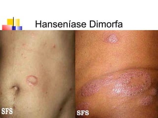 Hanseníase Dimorfa
 