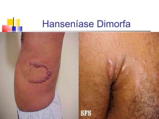 Hanseníase Dimorfa
 