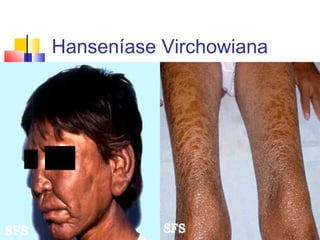 Hanseníase Virchowiana
 