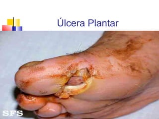 Úlcera Plantar
 