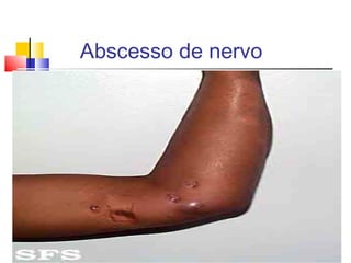 Abscesso de nervo
 