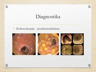 Diagnostika
• Kolonoskopija - pseidomembrānas
 