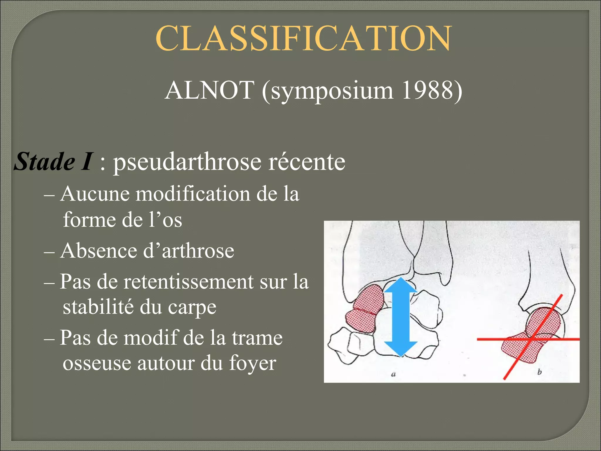 CLASSIFICATION
ALNOT (symposium 1988)
Stade I : pseudarthrose récente
– Aucune modification de la

forme de l’os
– Absence d’arthrose
– Pas de retentissement sur la
stabilité du carpe
– Pas de modif de la trame
osseuse autour du foyer

 