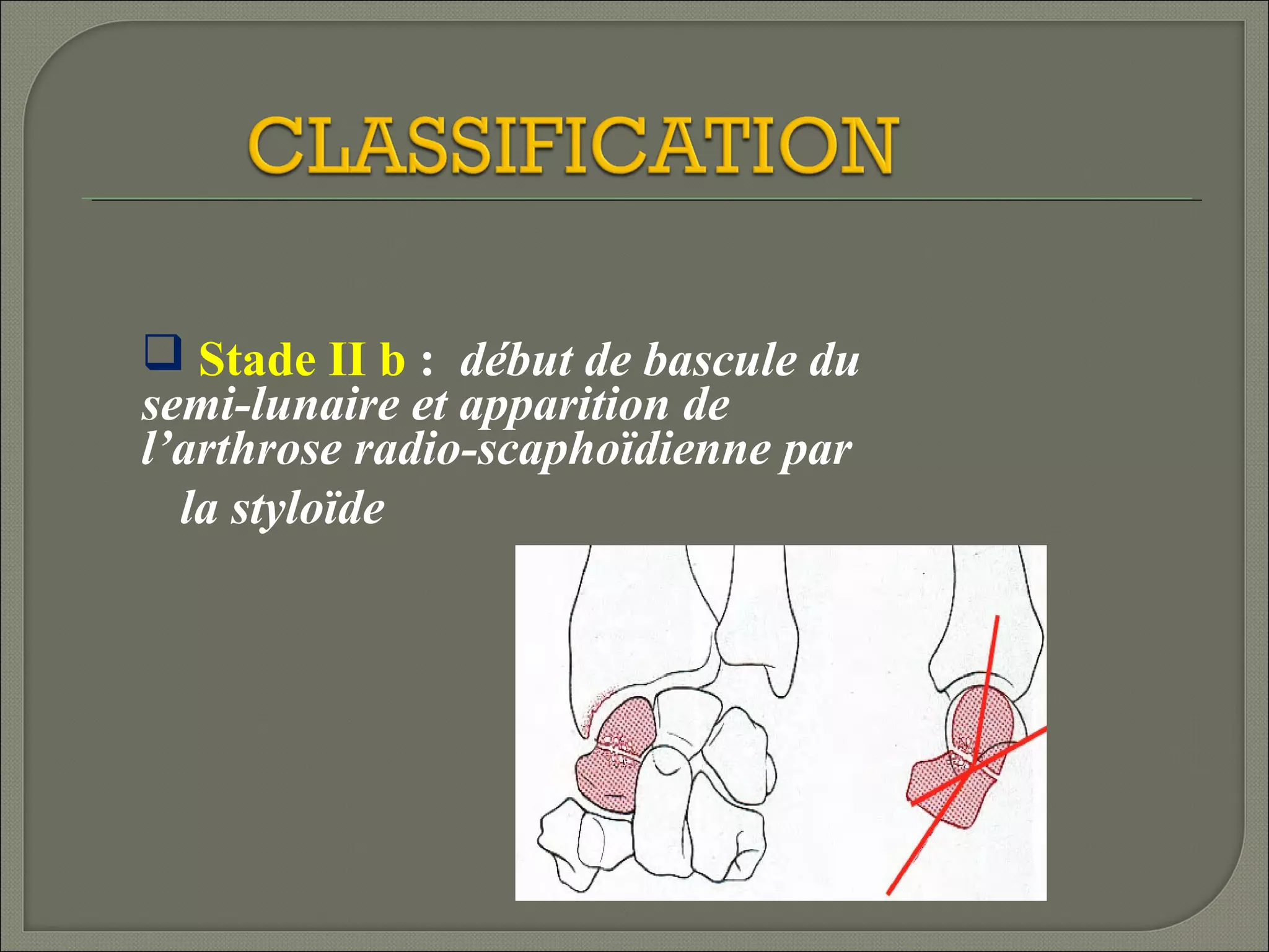  Stade II b : début de bascule du
semi-lunaire et apparition de
l’arthrose radio-scaphoïdienne par
la styloïde

 