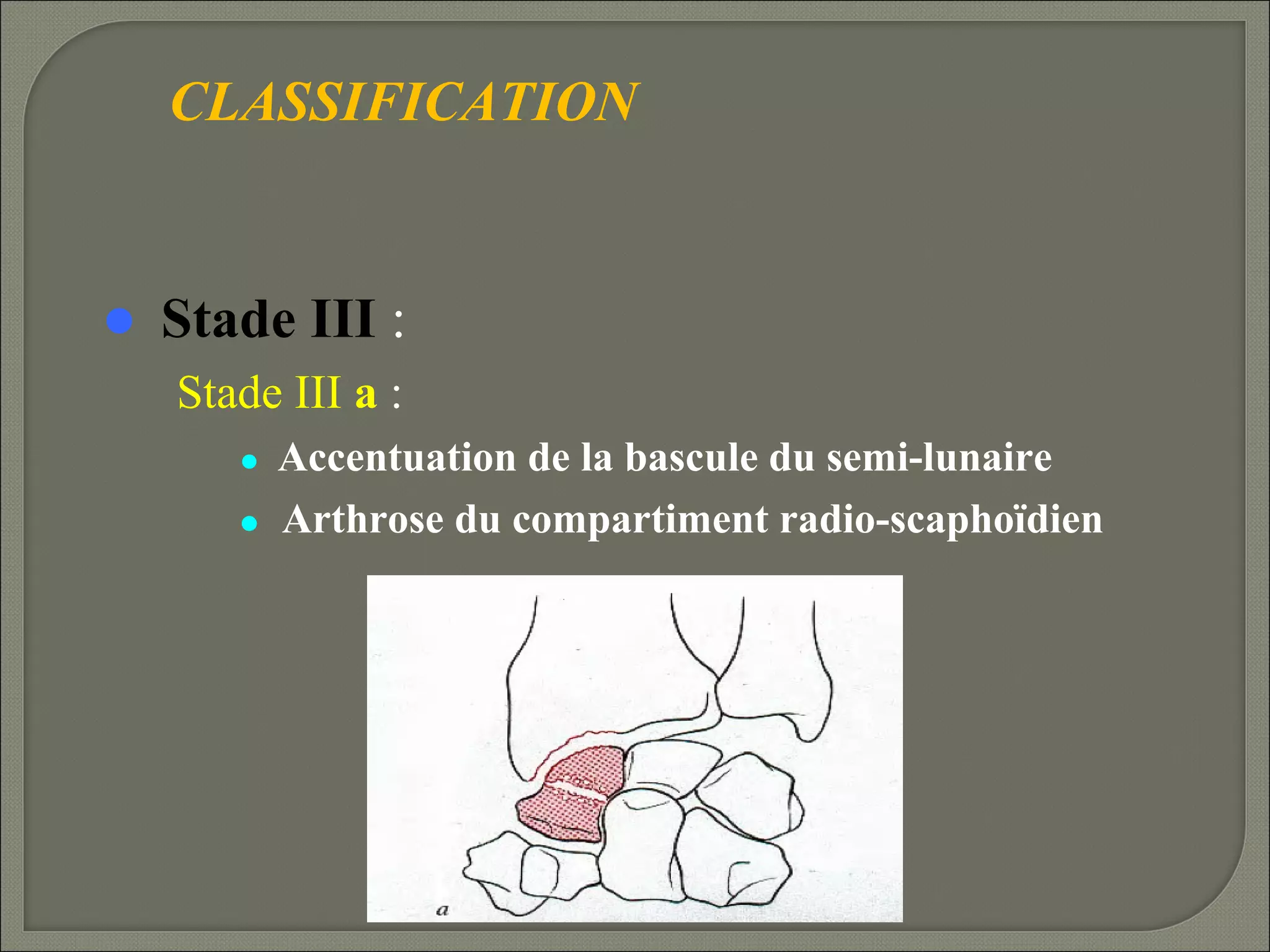 CLASSIFICATION



Stade III :
Stade III a :
Accentuation de la bascule du semi-lunaire
 Arthrose du compartiment radio-scaphoïdien


 