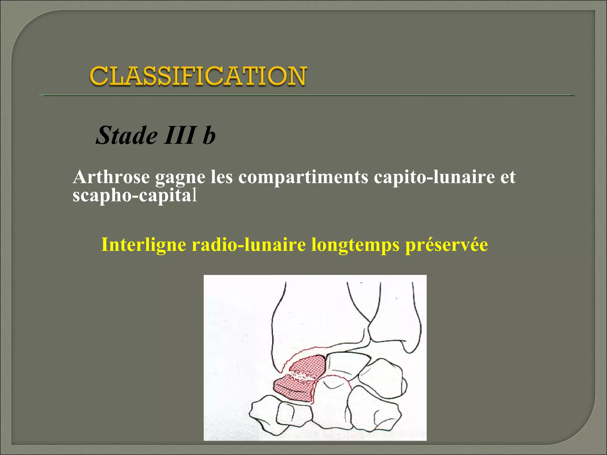Stade III b
Arthrose gagne les compartiments capito-lunaire et
scapho-capital
Interligne radio-lunaire longtemps préservée

 