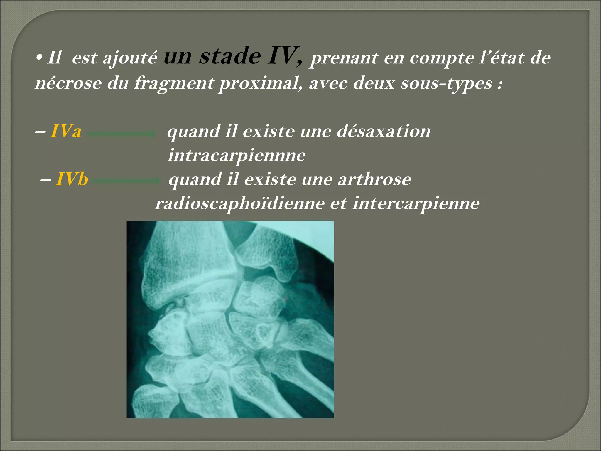 • Il est ajouté un stade IV, prenant en compte l’état de
nécrose du fragment proximal, avec deux sous-types :
– IVa
– IVb

quand il existe une désaxation
intracarpiennne
quand il existe une arthrose
radioscaphoïdienne et intercarpienne

 