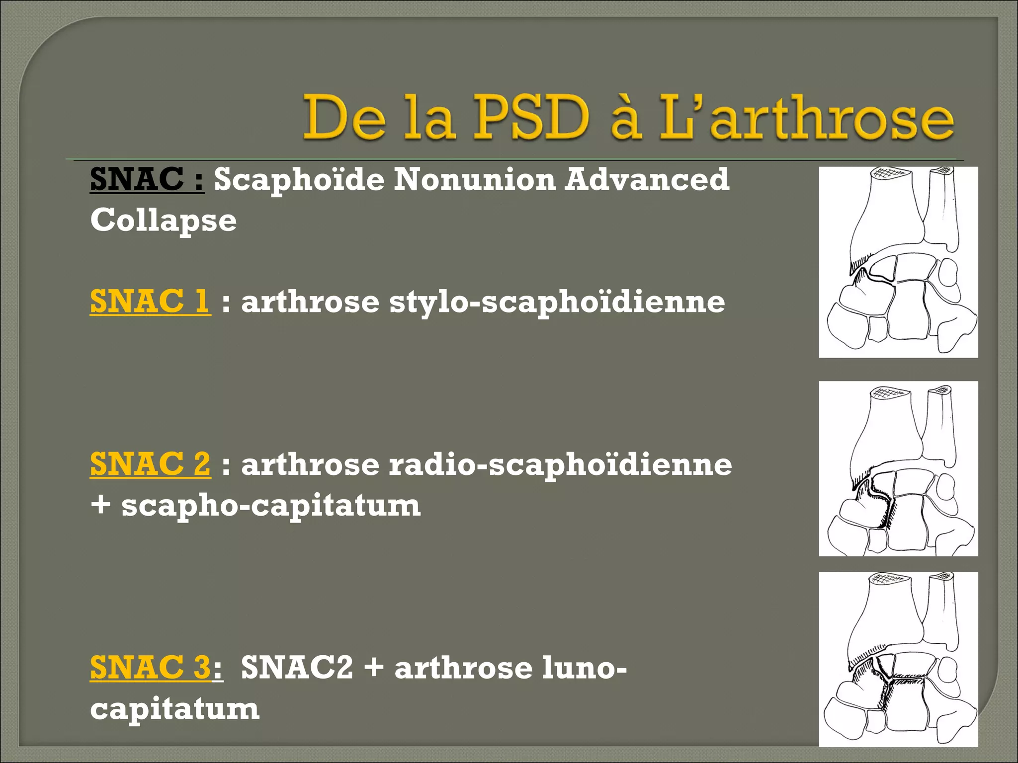 SNAC : Scaphoïde Nonunion Advanced
Collapse
SNAC 1 : arthrose stylo-scaphoïdienne

SNAC 2 : arthrose radio-scaphoïdienne
+ scapho-capitatum

SNAC 3: SNAC2 + arthrose lunocapitatum

 