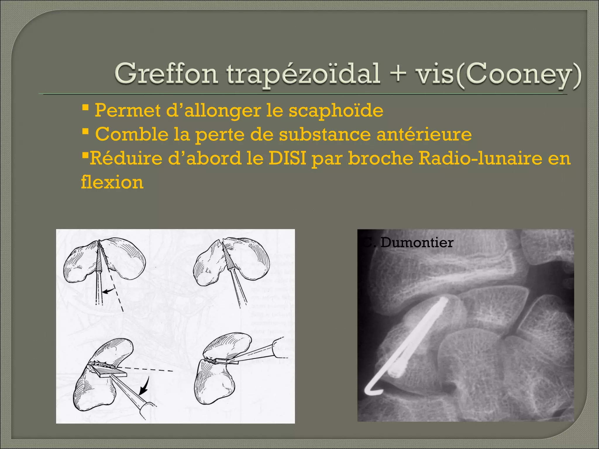  Permet d’allonger le scaphoïde
 Comble la perte de substance antérieure
Réduire d’abord le DISI par broche Radio-lunaire en
flexion
C. Dumontier

 