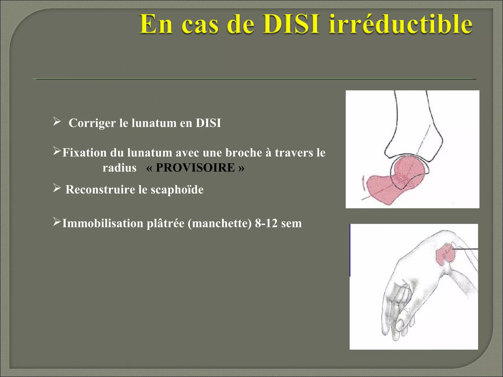 Corriger le lunatum en DISI
Fixation du lunatum avec une broche à travers le
radius « PROVISOIRE »
 Reconstruire le scaphoïde
Immobilisation plâtrée (manchette) 8-12 sem

 