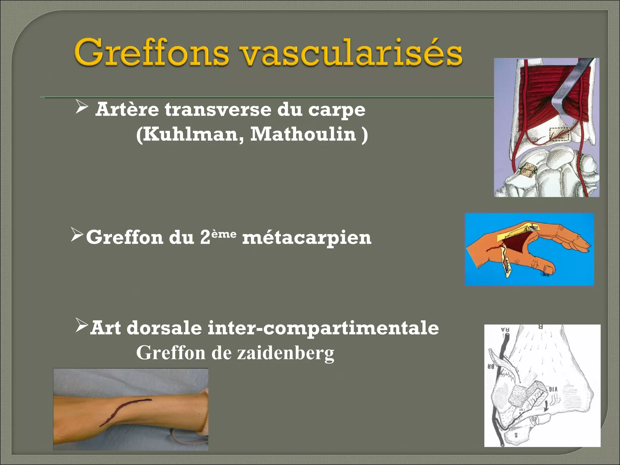  Artère transverse du carpe
(Kuhlman, Mathoulin )

Greffon du 2ème métacarpien

Art dorsale inter-compartimentale
Greffon de zaidenberg

 
