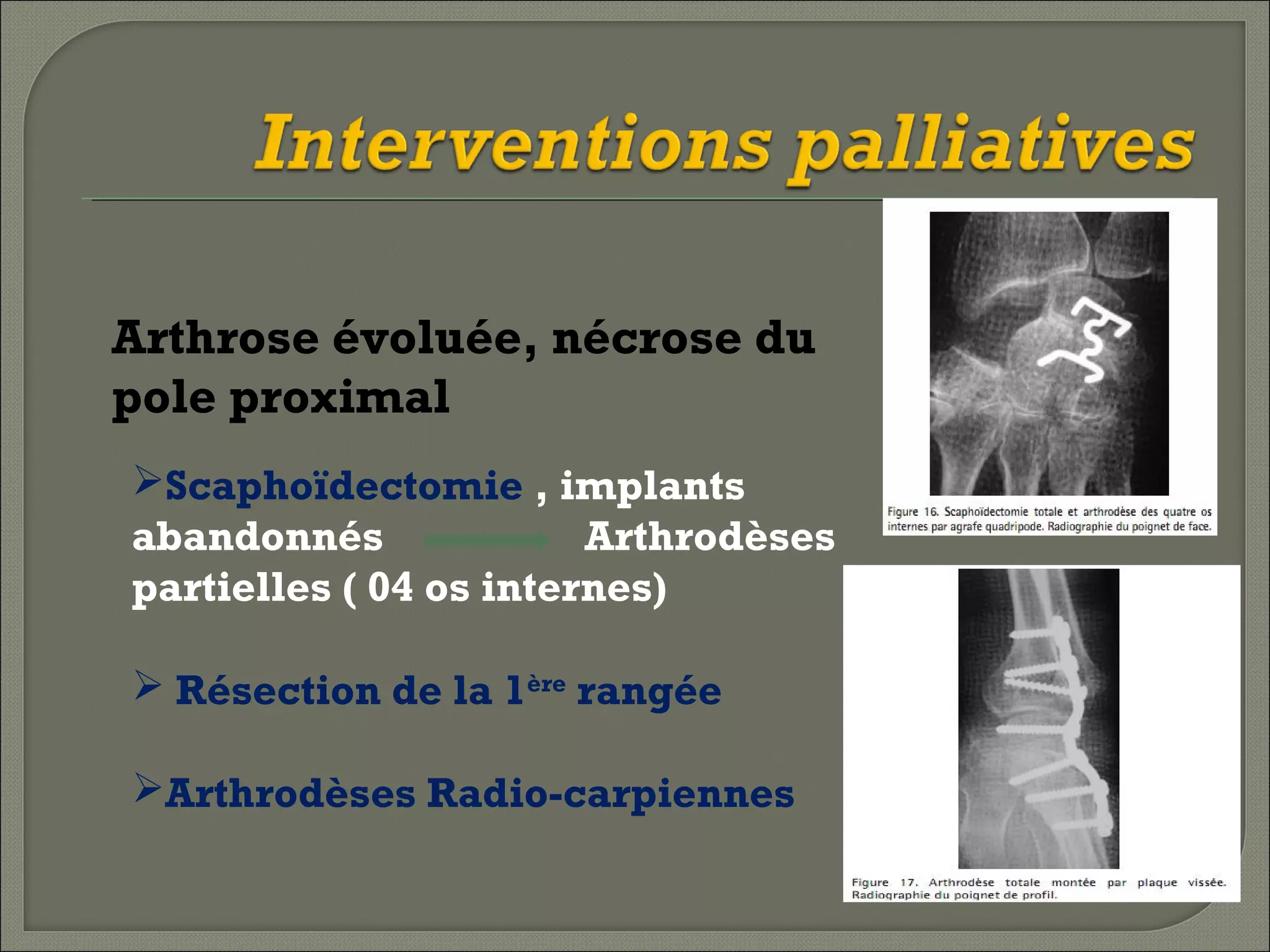Arthrose évoluée, nécrose du
pole proximal
Scaphoïdectomie , implants
abandonnés
Arthrodèses
partielles ( 04 os internes)
 Résection de la 1ère rangée
Arthrodèses Radio-carpiennes

 