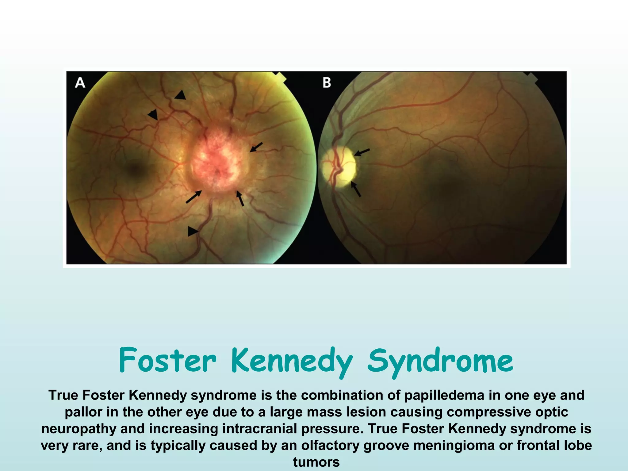 Foster Kennedy Syndrome
True Foster Kennedy syndrome is the combination of papilledema in one eye and
pallor in the other eye due to a large mass lesion causing compressive optic
neuropathy and increasing intracranial pressure. True Foster Kennedy syndrome is
very rare, and is typically caused by an olfactory groove meningioma or frontal lobe
tumors
 
