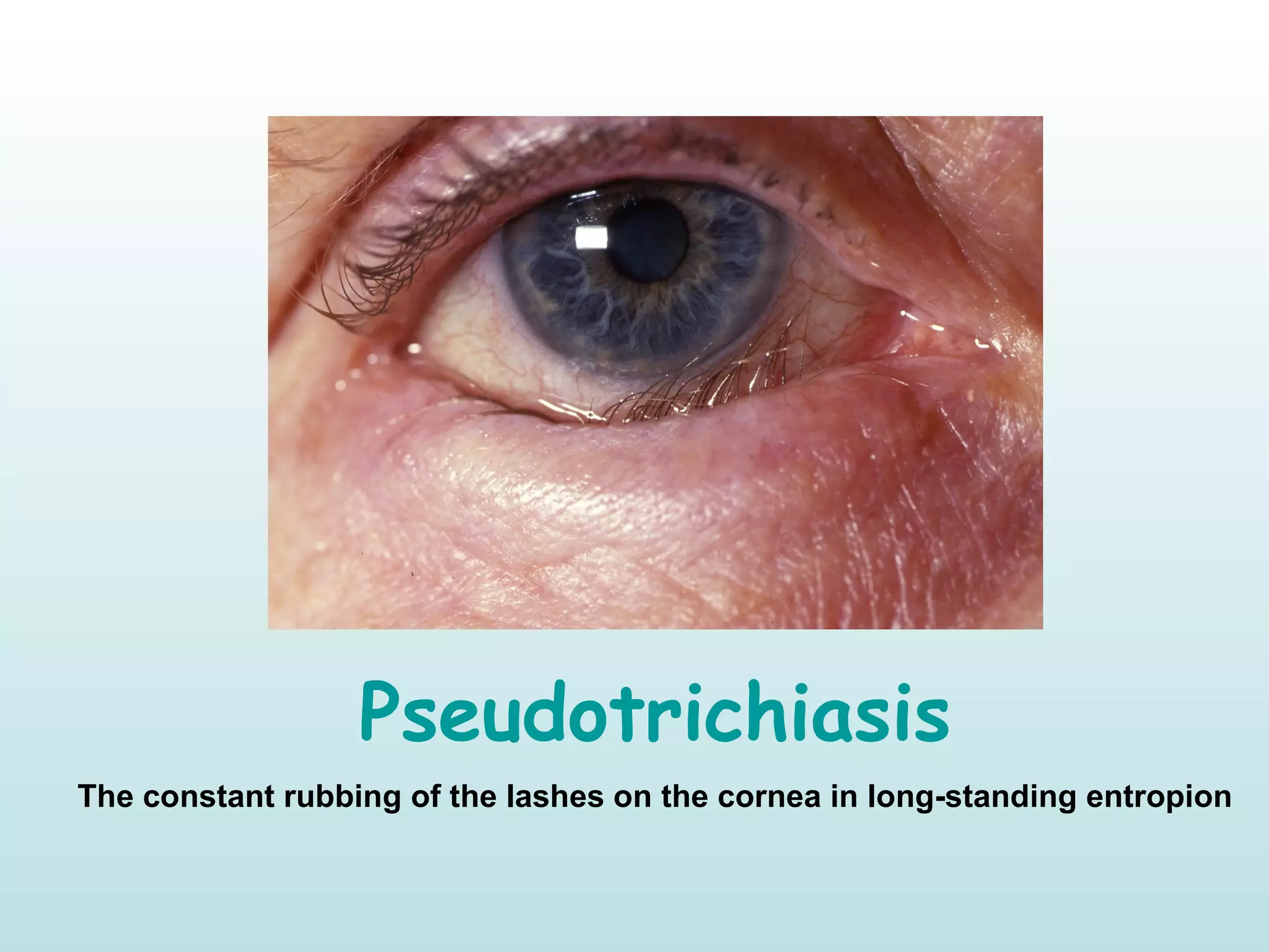Pseudotrichiasis
The constant rubbing of the lashes on the cornea in long-standing entropion
 